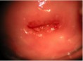 /album/fotogaleria-colposcopia/cuello-con-proceso-inflamatorio-jpg/